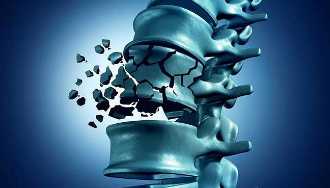 https://oneplusonepharma.com/wp-content/uploads/2025/04/osteoporosis.jpg